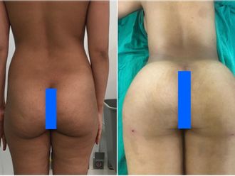 Chirurgie des fesses avant et après - 847363