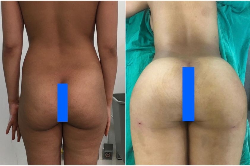 Chirurgie des fesses avant et après - 847363