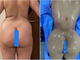 Chirurgie des fesses avant et après - 847364