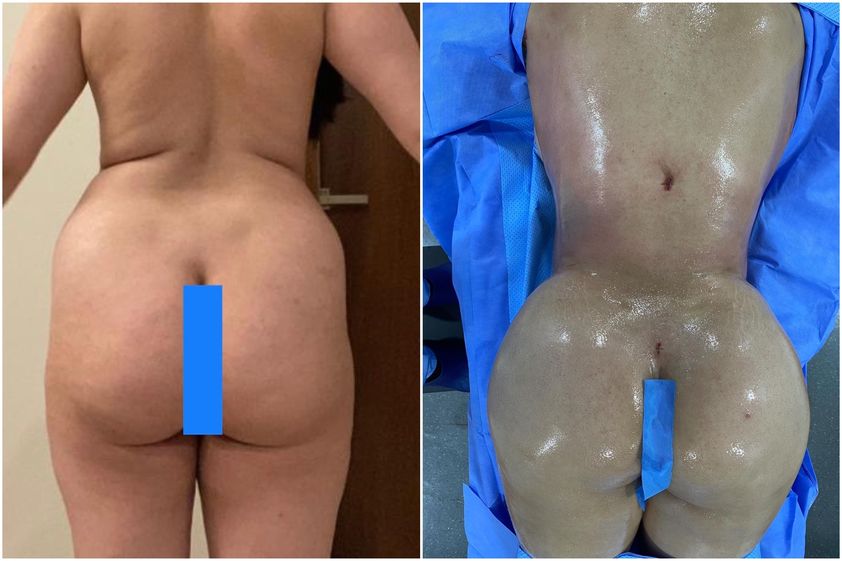 Chirurgie des fesses avant et après - 847364