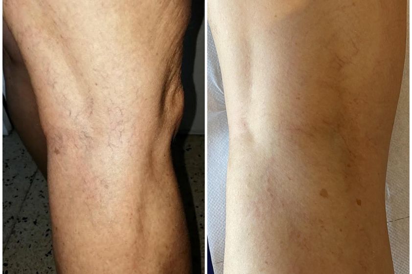 Varices avant et après - 792703