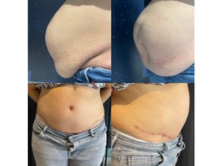 Cure de HO+diastasis avec prothèse intra-péritonéale par la cicatrice de césarienne - Dr Mariangela