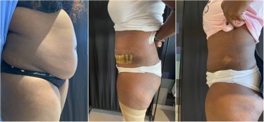 Cure de HO+diastasis avec prothèse intra-péritonéale par la cicatrice de césarienne - Dr Mariangela