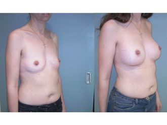 Implants mammaires avant et après - 551119