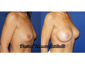 Implants mammaires avant et après - 572936