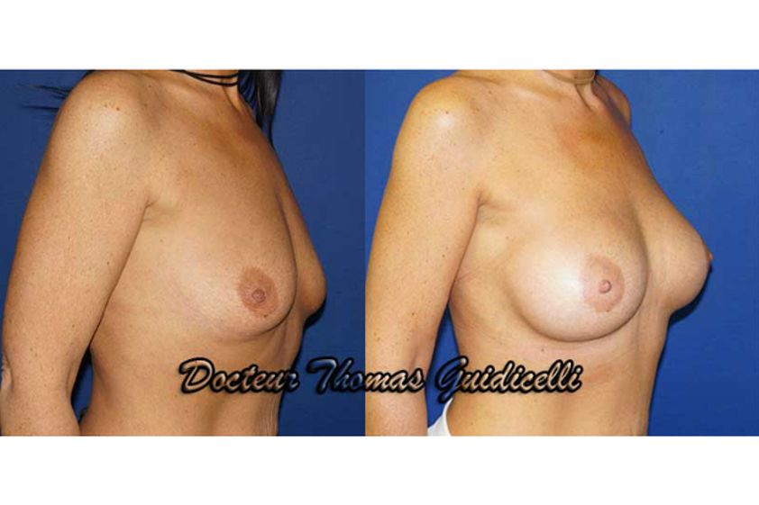 Implants mammaires avant et après - 572936