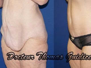 Avant après Abdominoplastie