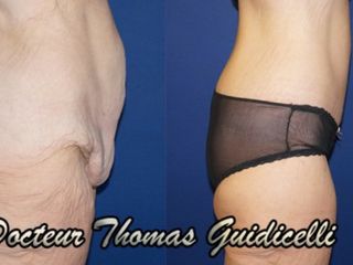 Avant après Abdominoplastie