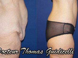 Abdominoplastie - 640310