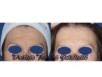 Botox - 641474