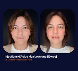Acide hyaluronique - Dr Alexandre Mertens