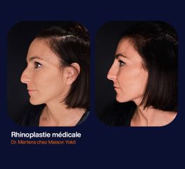 Rhinoplastie médicale - Dr Alexandre Mertens