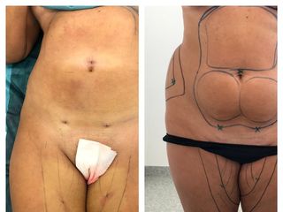 Avant Après Liposuccion
