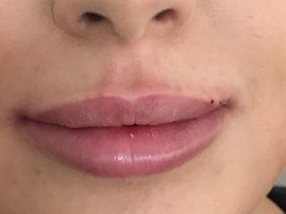 Après Augmentation des lèvres