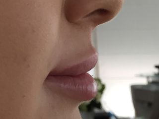 Après Augmentation des lèvres