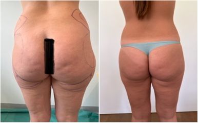 Liposuccion médicale - Dr Bertrand Delaoustre