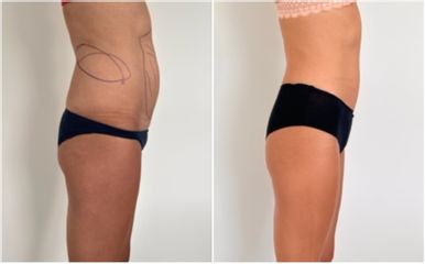 Liposuccion médicale - Dr Bertrand Delaoustre