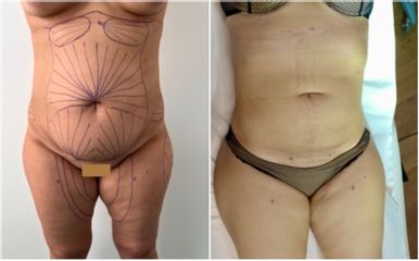 Liposuccion médicale - Dr Bertrand Delaoustre