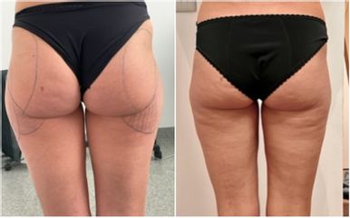 Liposuccion médicale - Dr Bertrand Delaoustre