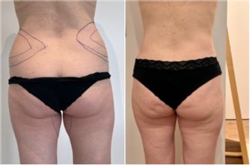 Liposuccion médicale - Dr Bertrand Delaoustre
