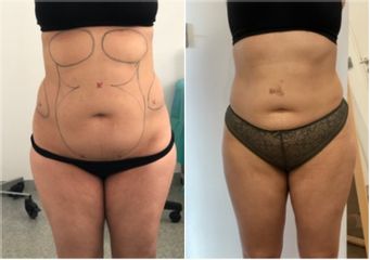 Liposuccion médicale - Dr Bertrand Delaoustre