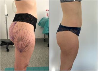 Liposuccion médicale - Dr Bertrand Delaoustre