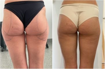 Liposuccion médicale - Dr Bertrand Delaoustre