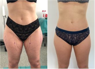 Liposuccion médicale - Dr Bertrand Delaoustre