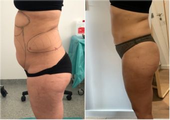 Liposuccion médicale - Dr Bertrand Delaoustre