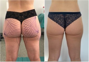 Liposuccion médicale - Dr Bertrand Delaoustre