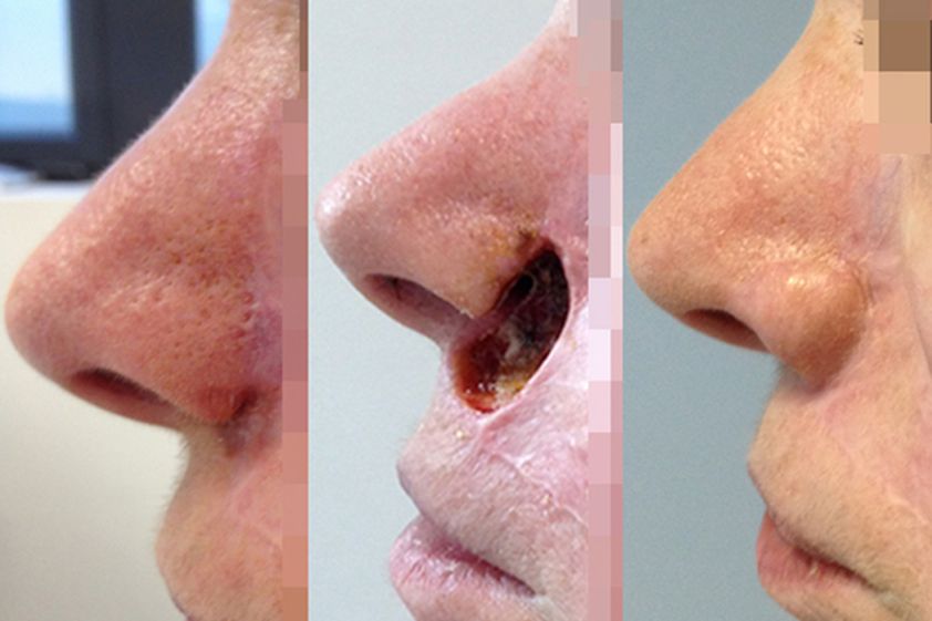 Chirurgie reconstructrice avant et après - 544948