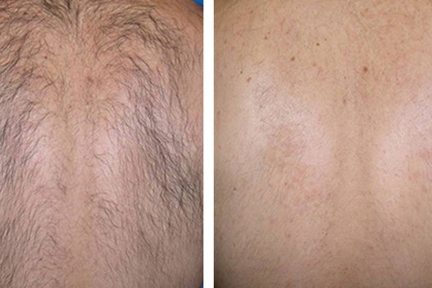 Épilation Laser avant et après - 578892