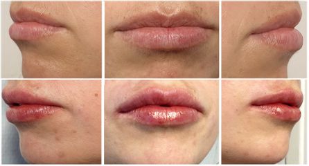 Augmentation des lèvres - Dr Marianne Cayatte