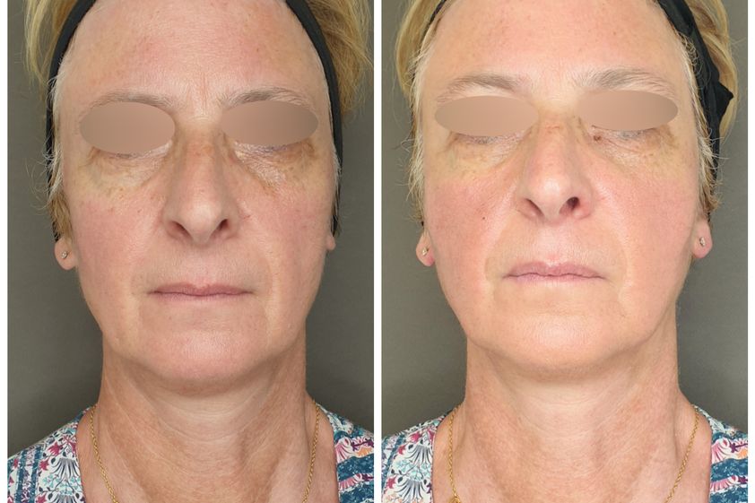 Microneedling avant et après - 829011
