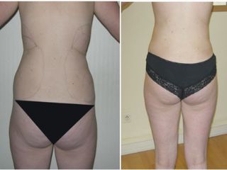 Avant après Liposuccion