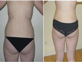 Liposuccion - 646879