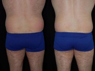 Avant après coolsculpting