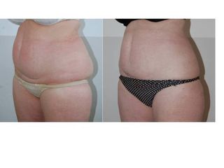 COOLSCULPTING HANCHES ET VENTRE
