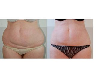 Avant après Coolsculpting des hanches et du ventre