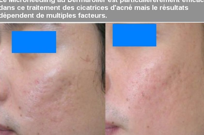 Microneedling avant et après - 573746