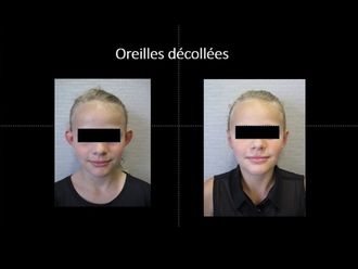 Otoplastie - 593969