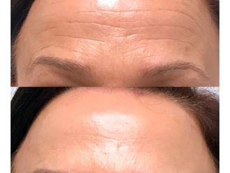 Botox - 643907