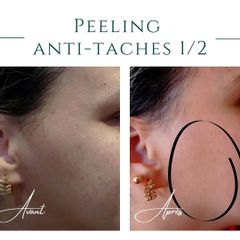 Peeling - Dr Eric Pietri