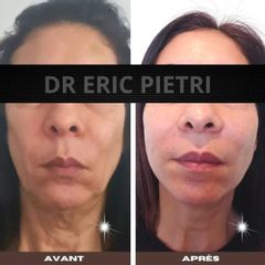 Fils tenseurs - Dr Eric Pietri