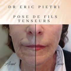 Fils tenseurs - Dr Eric Pietri