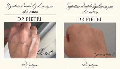 Acide Hyaluronique - Dr Eric Pietri
