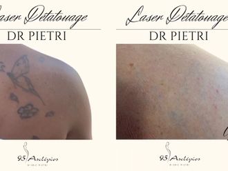 Détatouage avant et après - 860424