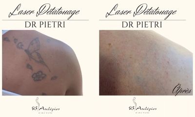 Détatouage - Dr Eric Pietri
