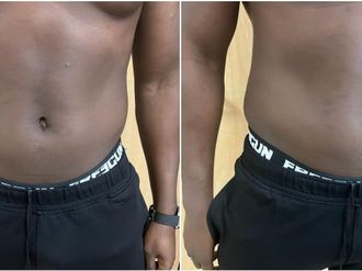 EMSculpt® avant et après - 841079