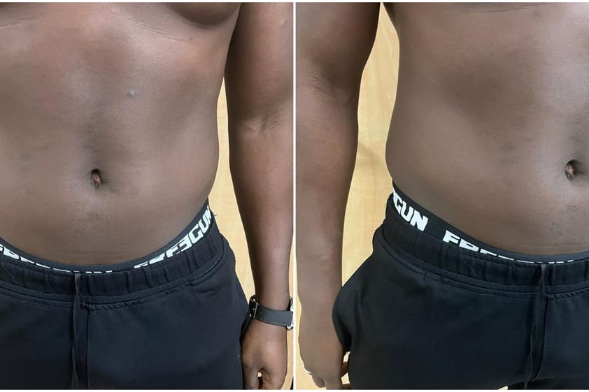 EMSculpt® avant et après - 841079